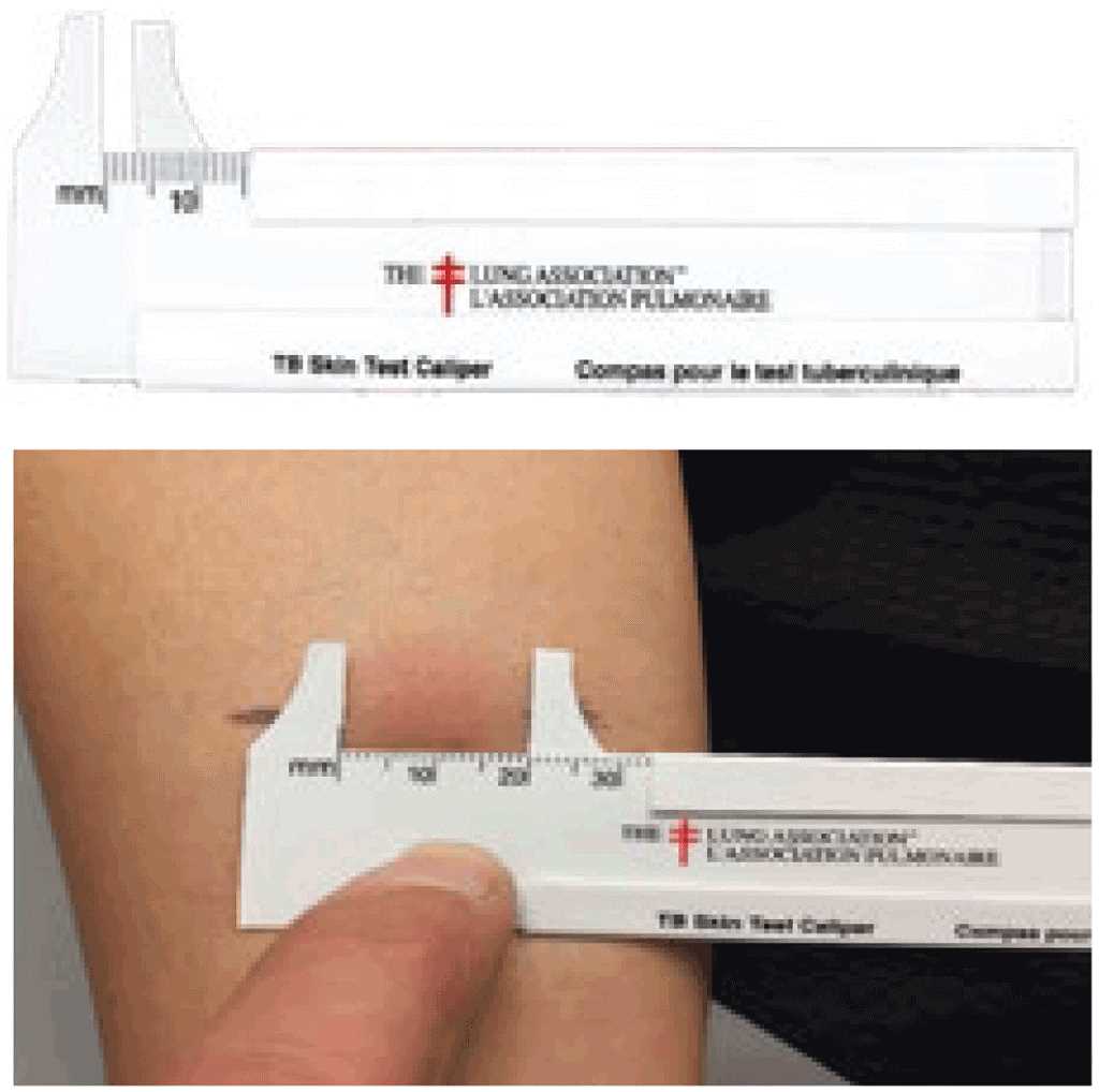 printable tb skin test form printable tb skin test form